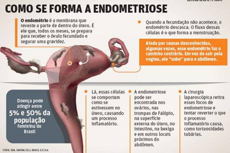 Você sabe o que é a endometriose? Tribuna de Parnaíba