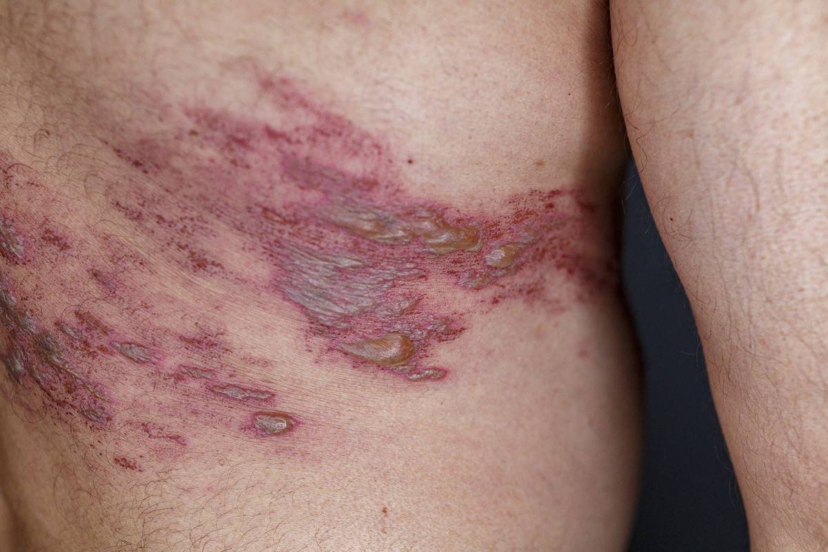 Ministério da Saúde pede incorporação de vacina contra o herpes-zóster (cobreiro) ao SUS 💉