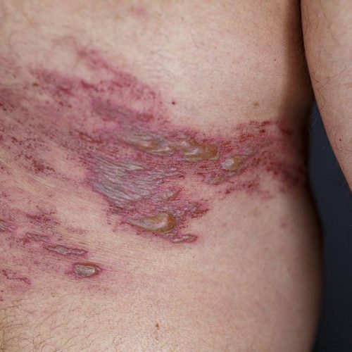 Ministério da Saúde pede incorporação de vacina contra o herpes-zóster (cobreiro) ao SUS 💉